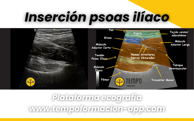 1. Anatomia y ecografia cadera tempo formacion.png